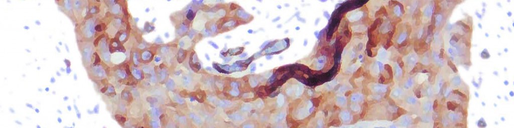 PODXL– ett prognostiskt protein vid cancer i urinblåsan