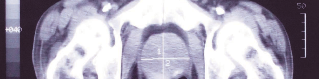 Överdiagnostik vid Prostatacancerscreening