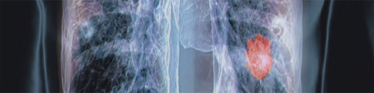 Målriktade terapier skapar positiv utveckling i lungcancervården