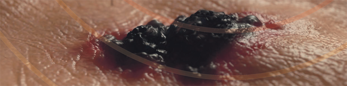 Nyheter inom melanomforskning