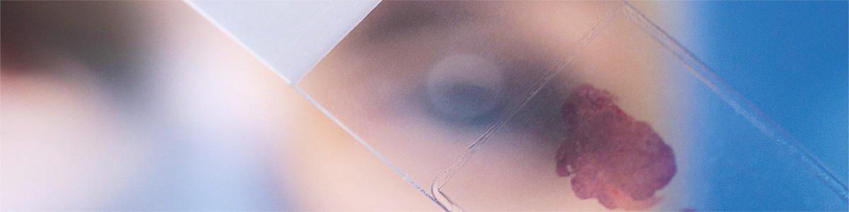 Vad kan analyser av cellfritt tumör-DNA bidra med?