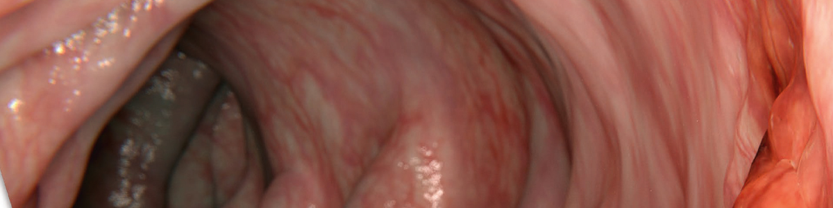 Studie om rektalcancer: Ny kunskap ger kirurger större frihet