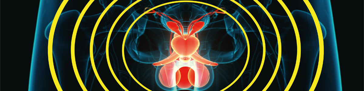 Organiserad prostatacancertestning – var står vi idag?