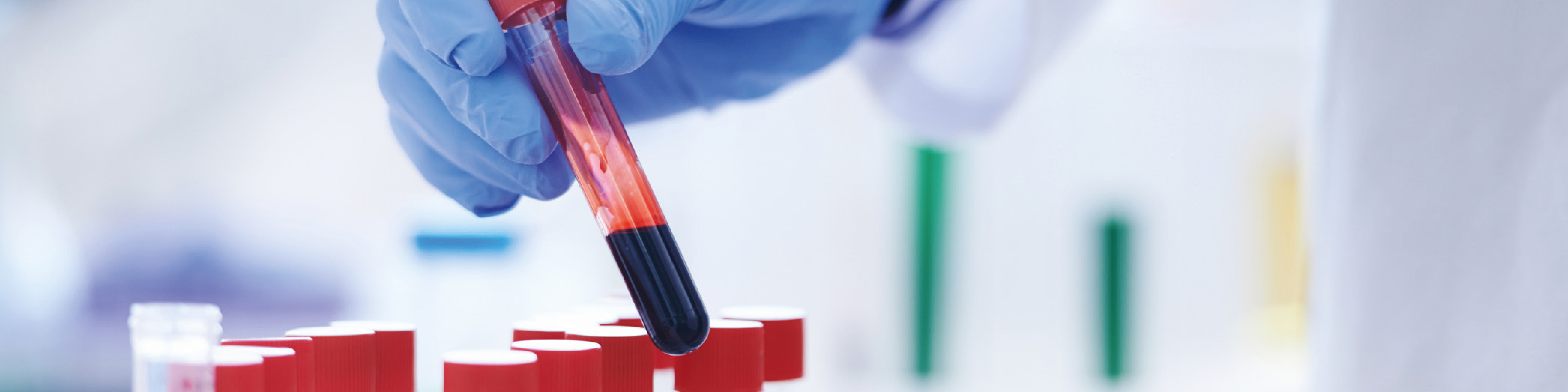 Blodprov kan visa risk för spridd bröstcancer – Kollagen IV som en tumörmarkör vid bröstcancer