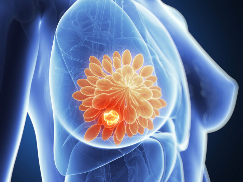 Bortom mammografi – kompletterande metoder inom bröströntgen