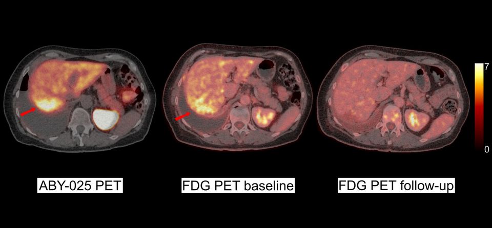 PET-scanning ger snabbare och mer träffsäker diagnos vid aggressiv bröstcancer