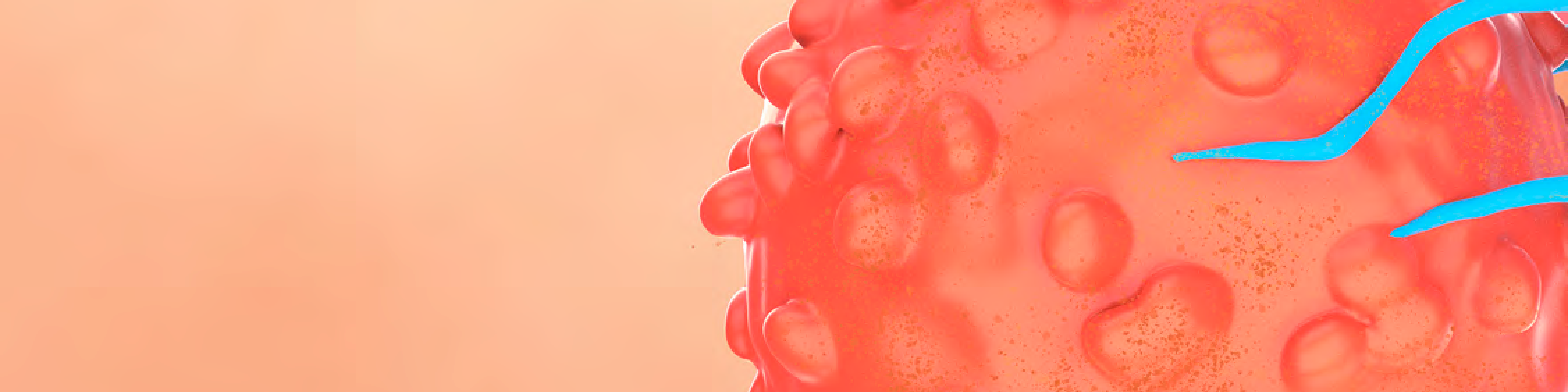 CAR T-cell therapy makes its mark in CLL