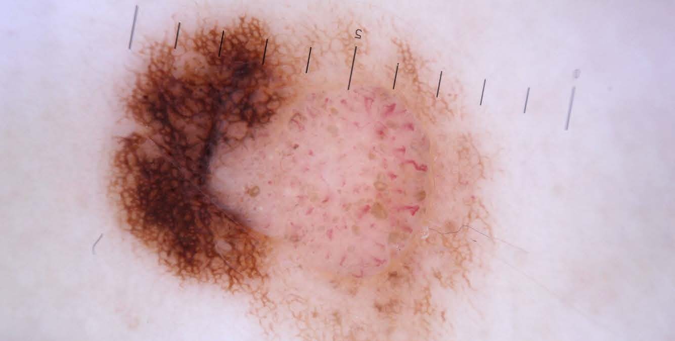 Ökad överlevnad med svårbehandlad malignt melanom